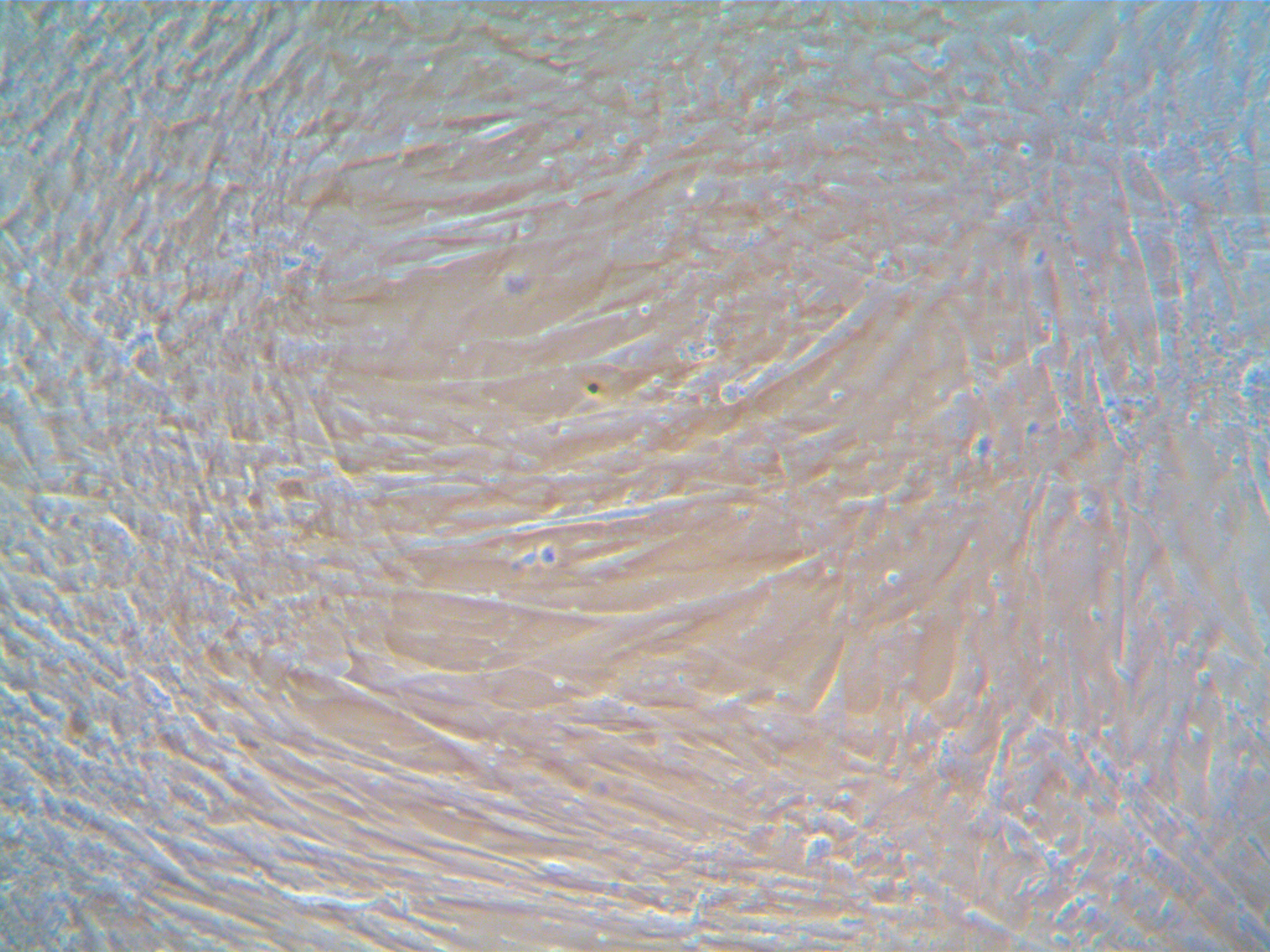 Human Lung Cancer-Associated Fibroblasts (CAF) Adenocarcinoma