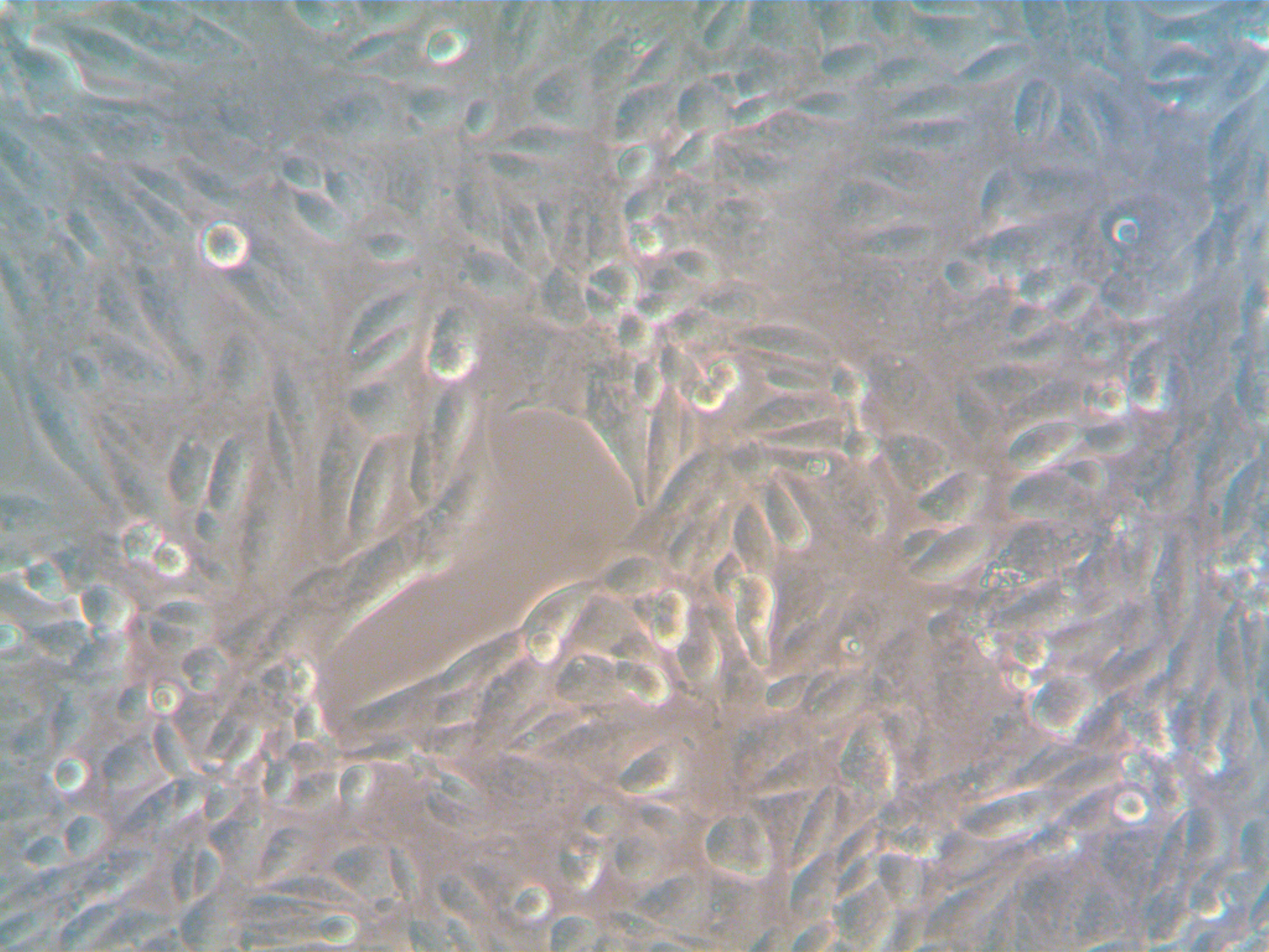 Human Metastatic Ovarian Cancer-Associated Fibroblasts (CAF)